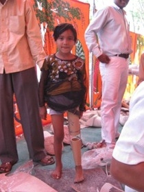 Standing tall with her  Jaipur foot