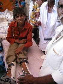 Polio Patient supported by calipers