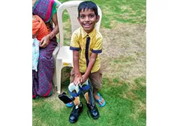 Calipers For Polio Legs India