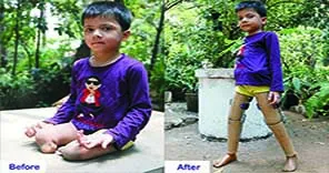 Send a Disabled Person in India to us for Free Jaipur Foot & Polio Legs Callipers