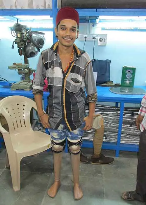 After Artificial Limb