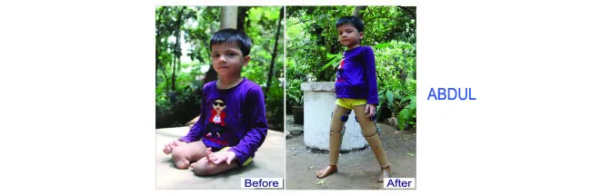 Abdul was provided Jaipur Foot