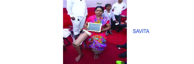 Savita was provided Artificial Leg