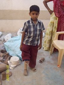 StandingtallwithhisJaipurfoot