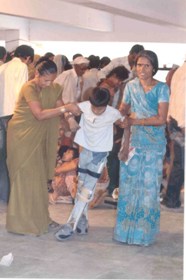 PolioPatientsupportedbycalipers